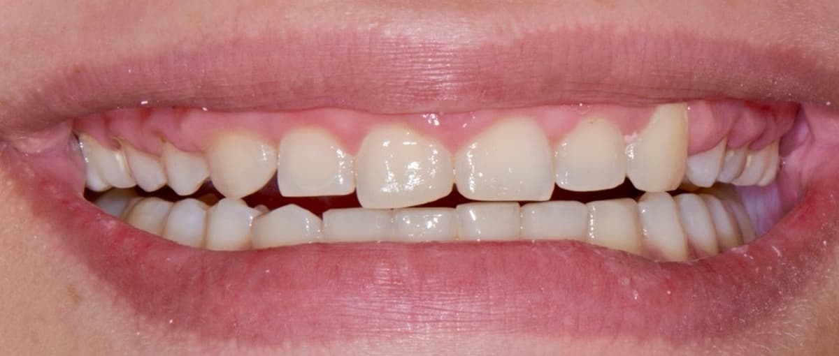 Full Smile Transformation & Bespoke Veneers - Before Treatment